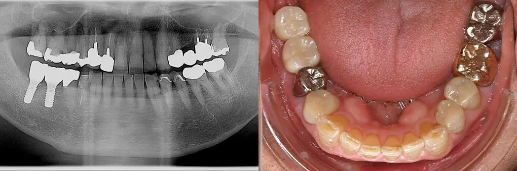 インプラント術後のレントゲン写真と口腔内写真（右下奥歯）