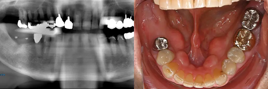 インプラント術前のレントゲン写真と口腔内写真（右下奥歯）