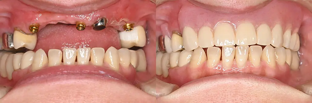 前歯義歯術後のレントゲン写真と口腔内写真