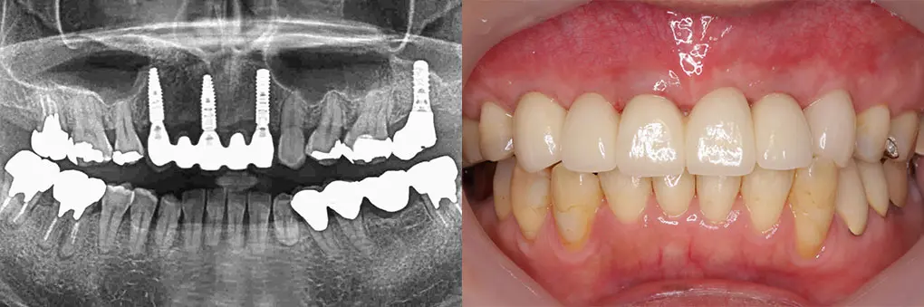 インプラント術後のレントゲン写真と口腔内写真（前歯）
