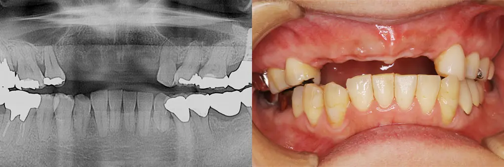 インプラント術前のレントゲン写真と口腔内写真（前歯）