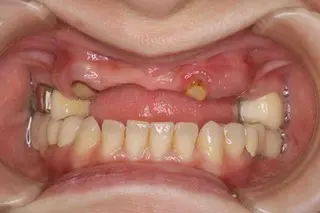 前歯義歯術前の口腔写真