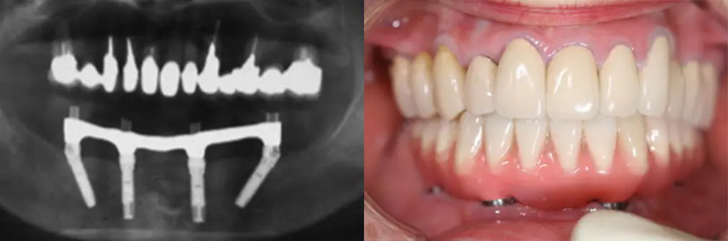 インプラント術後のレントゲン写真と口腔内写真