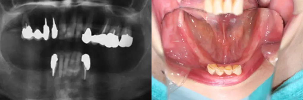 インプラント術前のレントゲン写真と口腔内写真