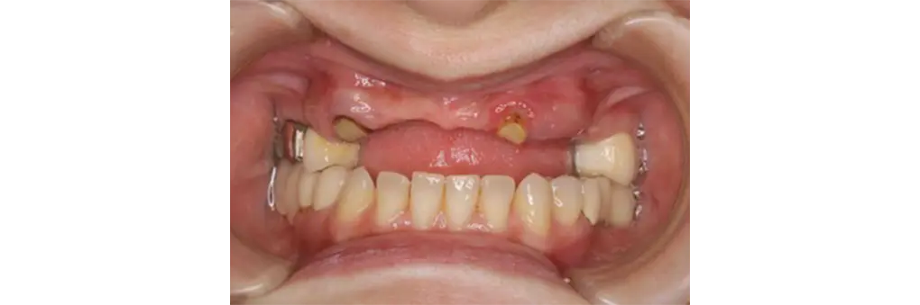 前歯義歯術前の口腔写真