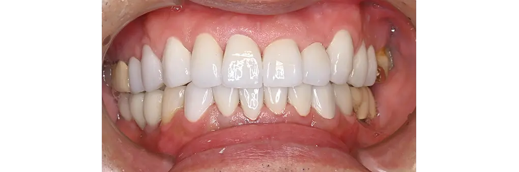 セラミック治療後の症例写真