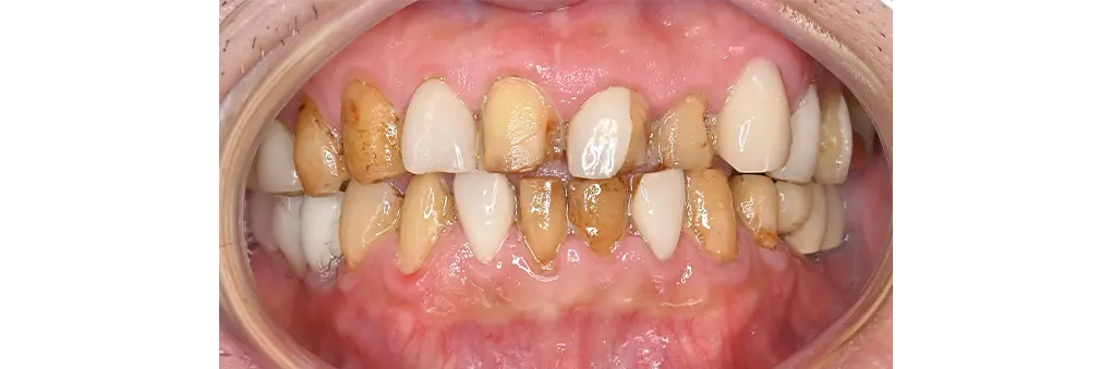 セラミック治療前の症例写真
