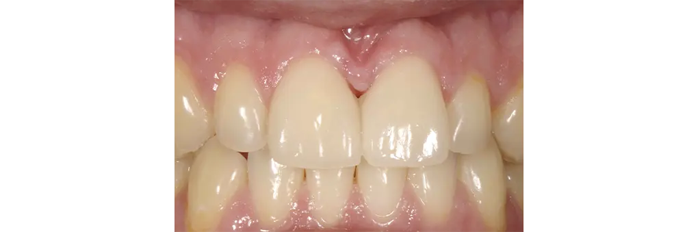 ラミネートベニア治療後の症例写真