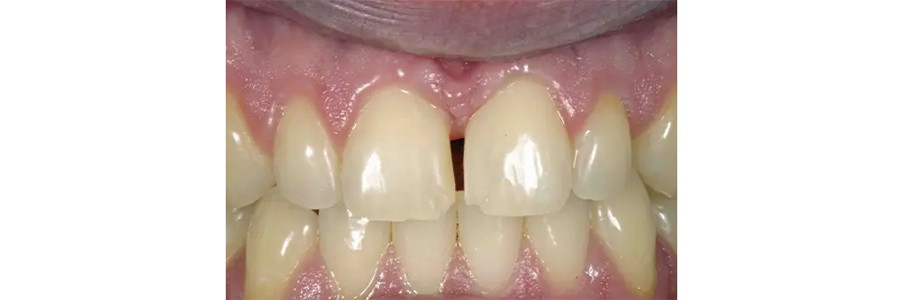 ラミネートベニア治療前の症例写真