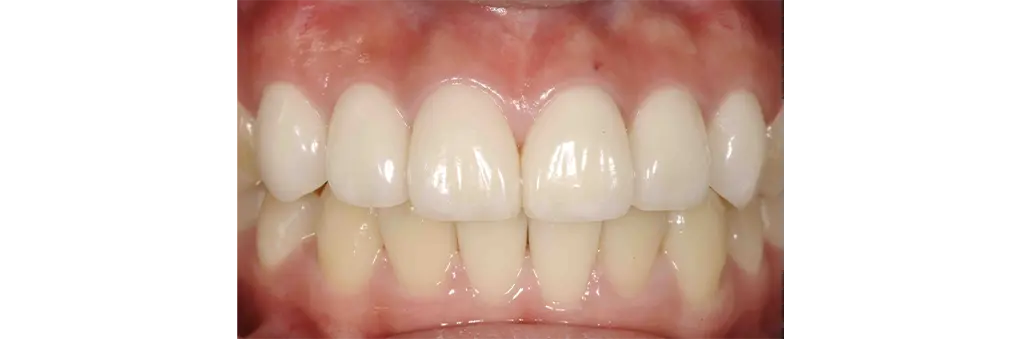 ラミネートベニア治療後の症例写真