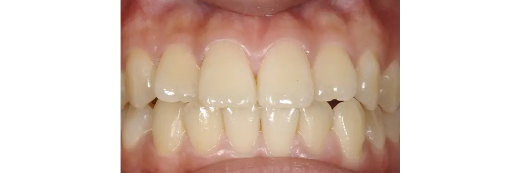 ラミネートベニア治療前の症例写真